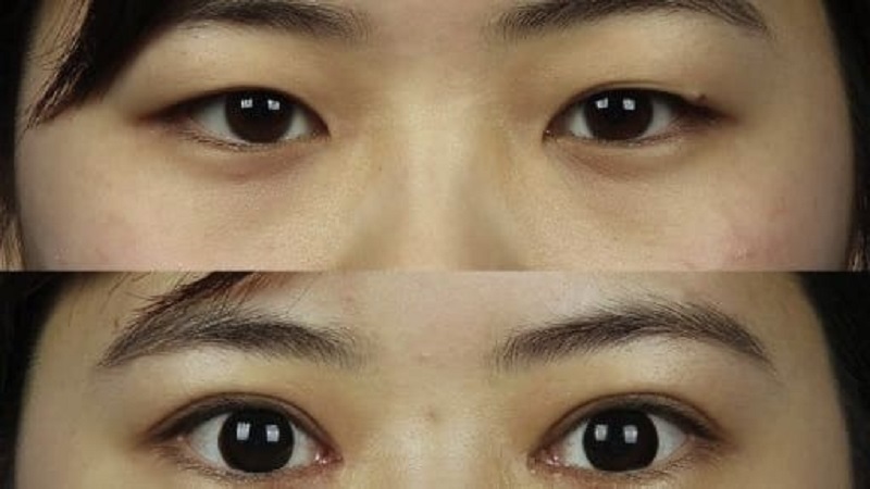 آناتومی صورت و چشمها در نژاد شرقی