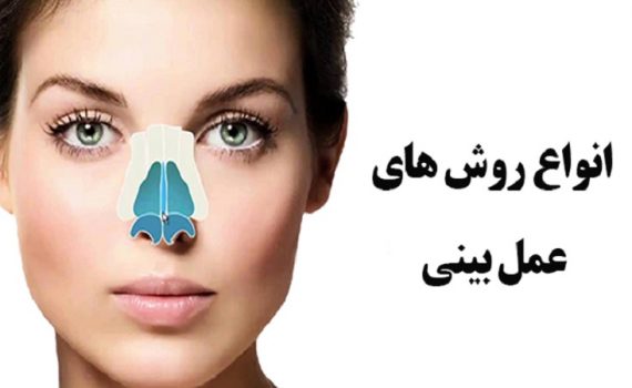 انواع روش های عمل بینی | جراح بینی اصفهان