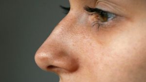 نشانه‌های پوست ضخیم چیست؟ | جراح بینی اصفهان