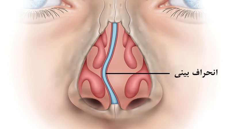 جراحی باز و بسته برای اصلاح انحراف بینی | جراح بینی اصفهان | دکتر اصغر معمار زاده
