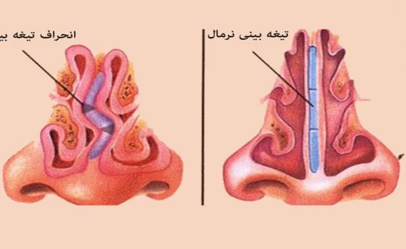 نقش ژنتیک در انحراف بینی | جراح بینی اصفهان | دکتر اصغر معمار زاده