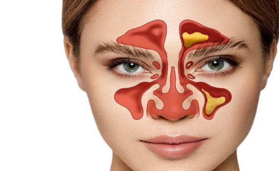 جراحی بینی و عفونت‌های سینوسی | جراح بینی اصفهان | دکتر اصغر معمار زاده