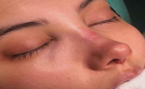 تأثیر جراحی بینی بر اختلالات خواب | جراح بینی اصفهان | دکتر اصغر معمار زاده