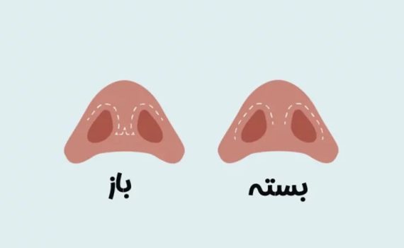 تفاوت جراحی بینی باز و بسته | جراح بینی اصفهان | دکتر اصغر معمار زاده