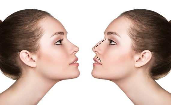 جراحی بینی استخوانی | جراح بینی اصفهان | دکتر اصغر معمار زاده