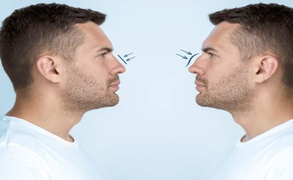 جراحی بینی مردانه | جراح بینی اصفهان | دکتر اصغر معمار زاده