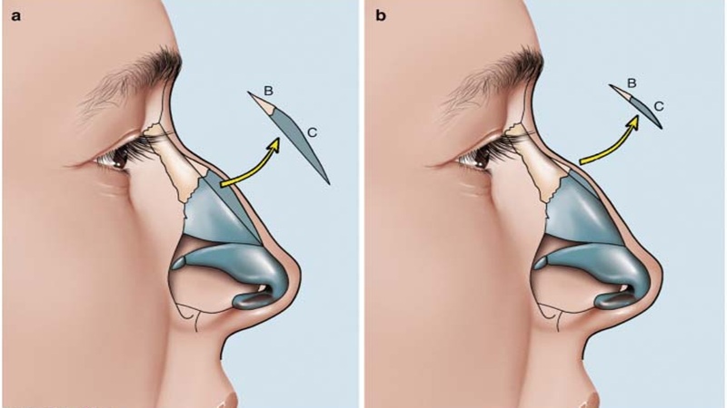 تفاوت جراحی بینی باز و بسته | جراح بینی اصفهان | دکتر اصغر معمار زاده